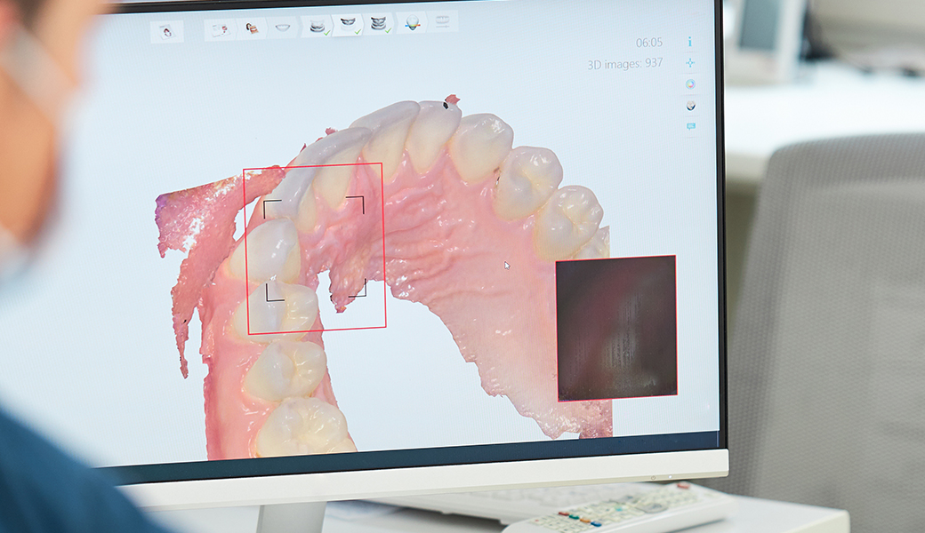 口腔内スキャナー：iTero