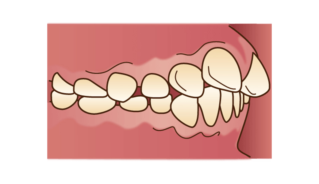 上顎前突（じょうがくぜんとつ）