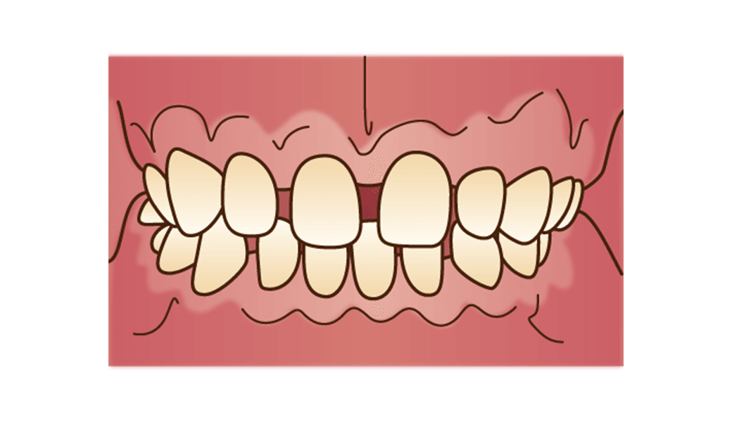 空隙歯列（くうげきしれつ）