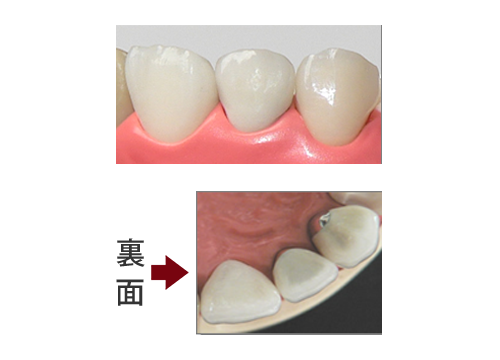 メタルセラミック¥165,000（プレシャス） ¥143,000（セミプレ） ¥99,000（コバルト連結6歯まで※保証なし）