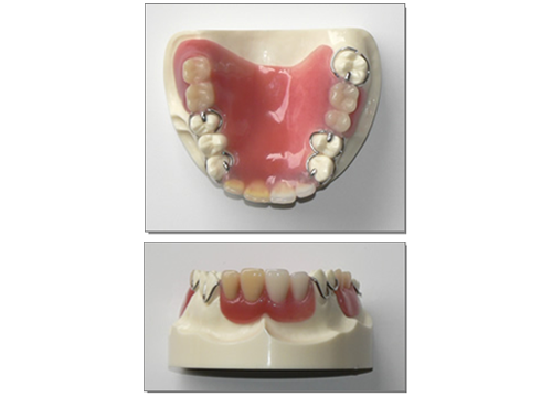 プラスチック義歯（保険適用）