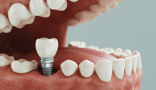 天然歯のような噛み心地を叶えるインプラント治療