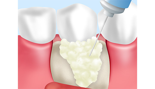 歯周組織再生療法（リグロス、エムドゲイン）