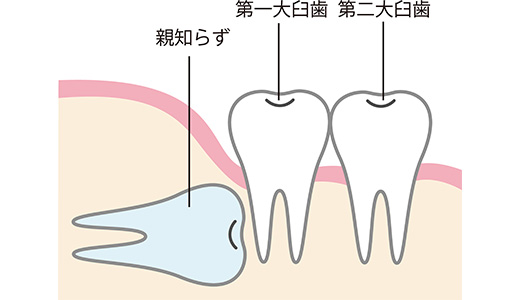 親知らずの抜歯