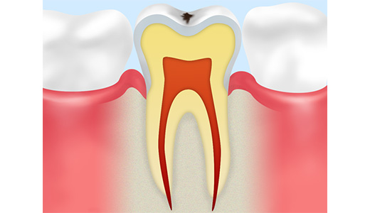 C1：初期の虫歯