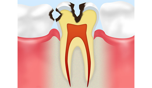 C2：本格的に進行し始めた虫歯