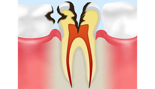 C3：神経まで進行した虫歯