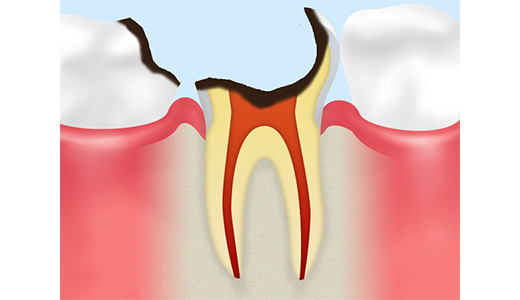 C4：ほとんど歯がない虫歯