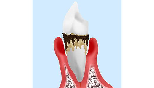 進行した歯周病には歯周外科治療を実施